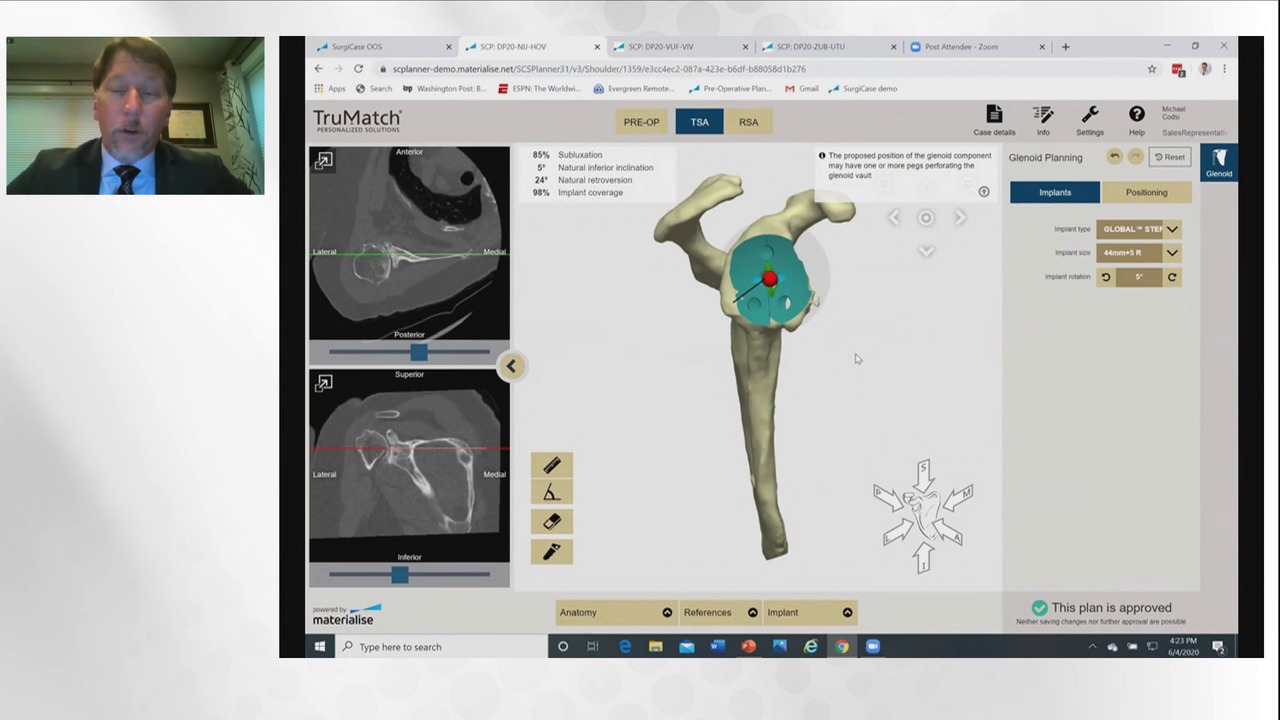 How Patient Specific Instrumentation Can Change Your Shoulder Practice: An ArthroTopic Discussion