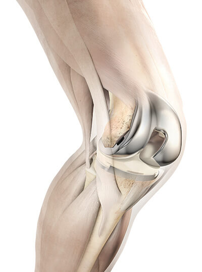 Attune_Knee
