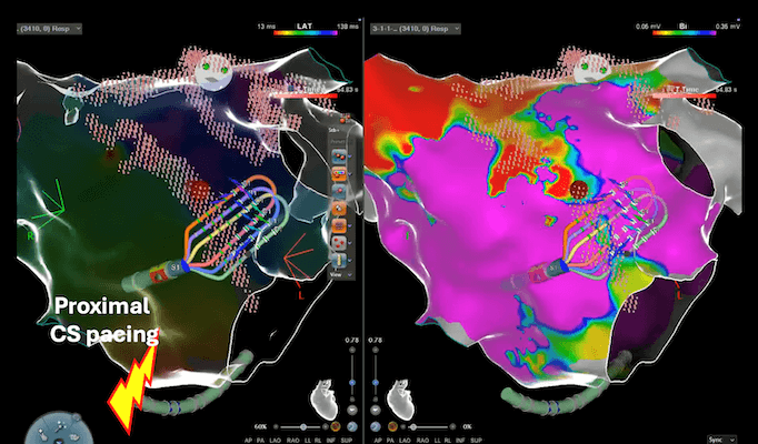 Left atrial map with OPTRELL™ Catheter and CARTO™ 3 system V8