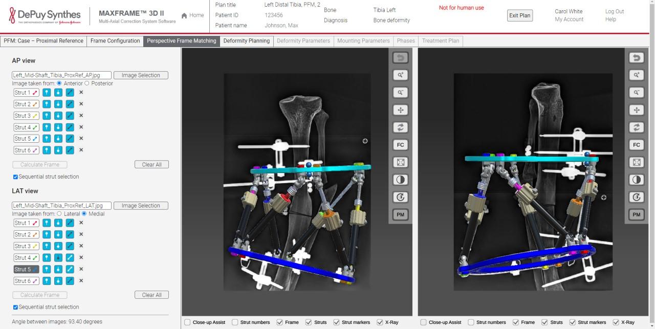 MAXFRAME Software Multi-Axial Correction System displaying Perspective Frame Matching from AP view and LAT view