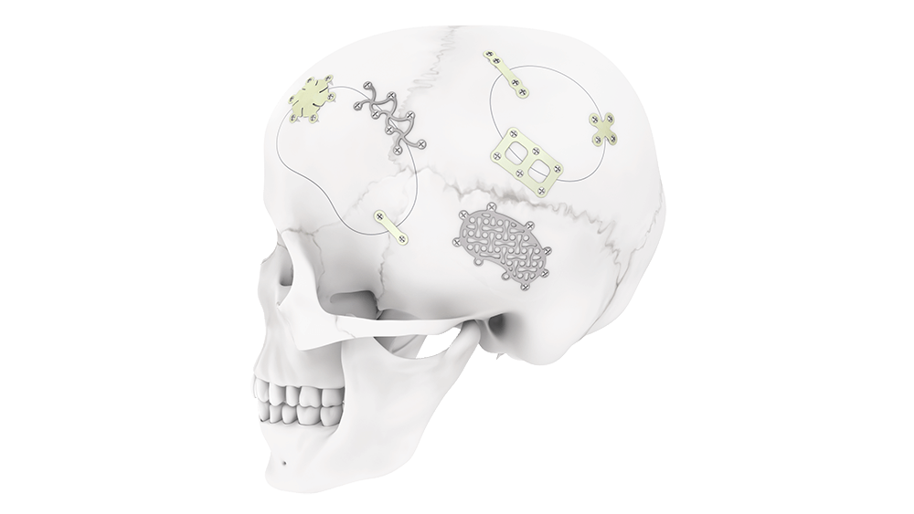 MatrixNEURO System implants shown on human skull