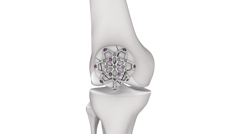Variable angle locking patella plate placed in joint