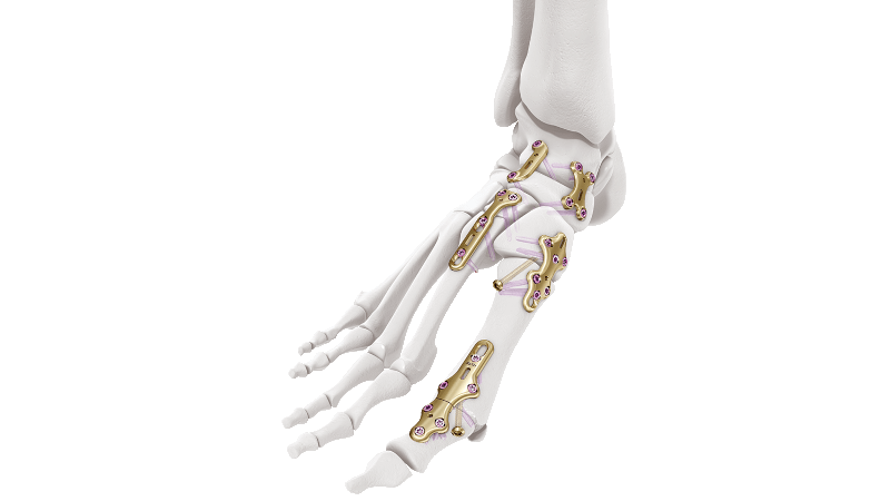 Variable Angle LCP Midfoot-Forefoot System medial column fusion plate in bone