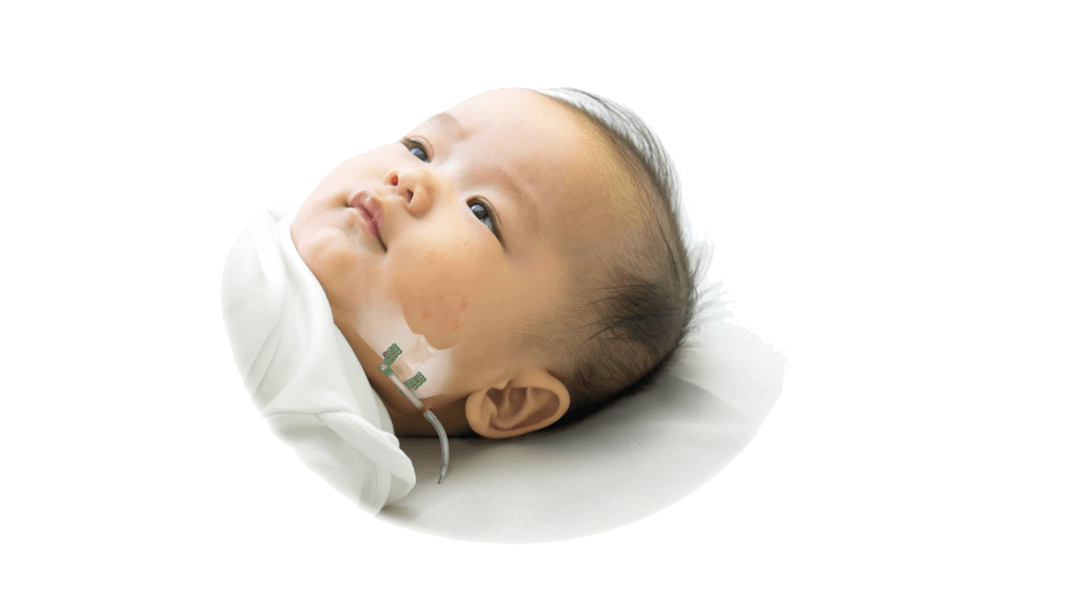 Craniomaxillifacial Distraction system shown on baby