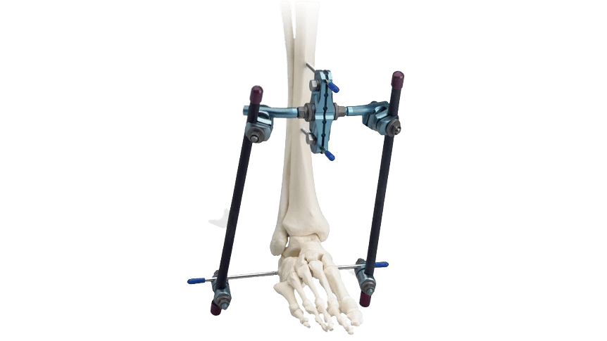 Large External Fixation System shown affixed to bones of the leg