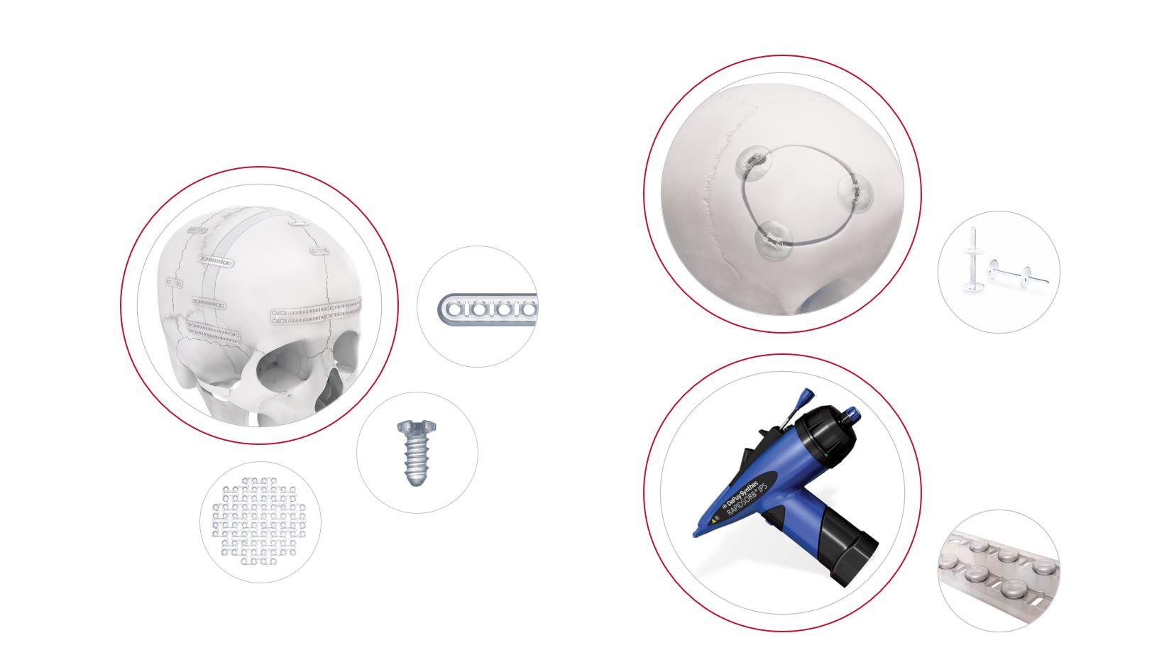 Screw, plate and mesh of the RAPIDSORB Rapid Resorbable Fixation System, RAPIDSORB Rapid Cranial Clamp and Injectable Polymer System shown individually and/or fixated on human skull.
