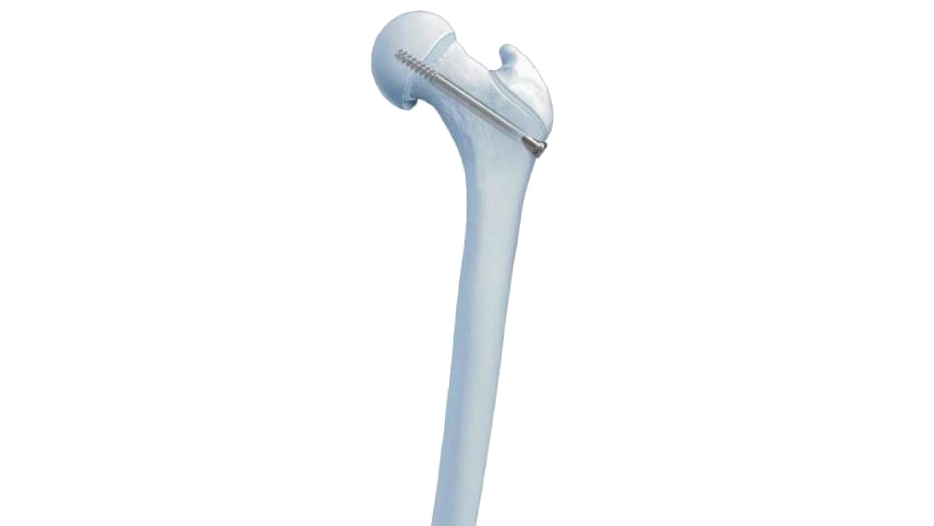 Slipped Capital Femoral Epiphysis Screw shown fixated in bone