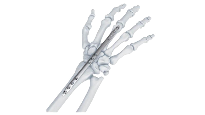 Wrist spanning plate attached to skeletal bones