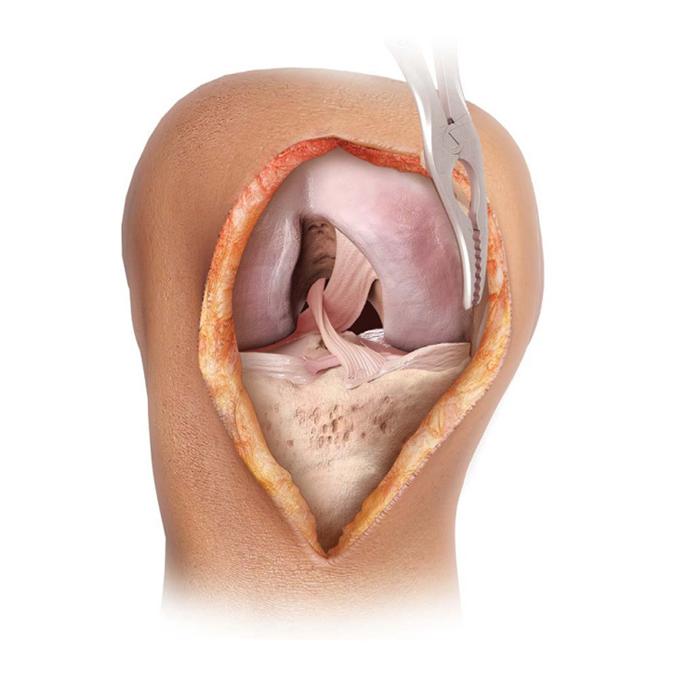 knee incision showing muscle and bone