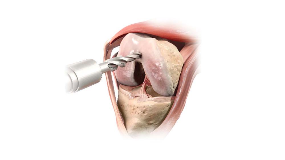 step drill drilling into knee