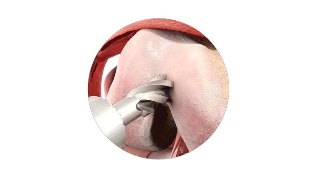 close-up of step drill drilling IM hole in knee
