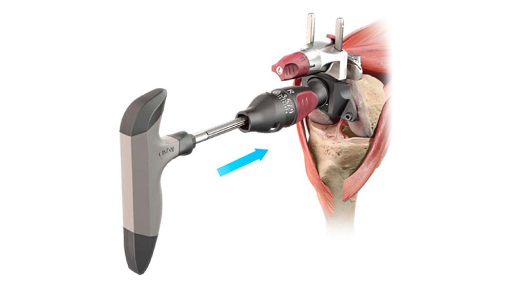 distal femoral jig inserted into knee joint