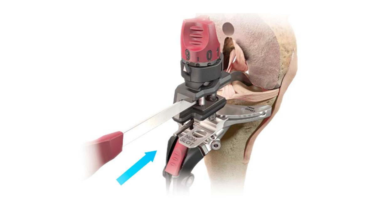 ATTUNE™ Knee System tibial stylus inserted into knee during total knee arthroplasty