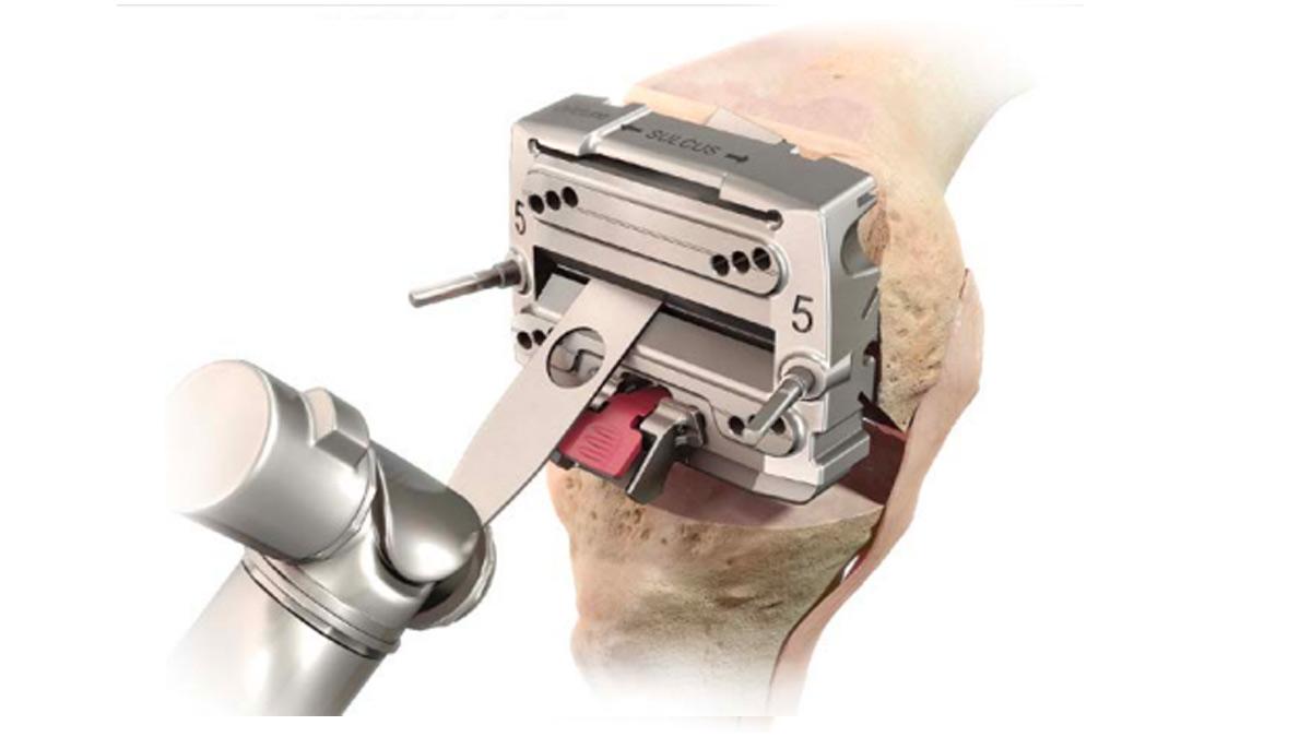 modular posterior saw inserted into knee during total knee arthroplasty