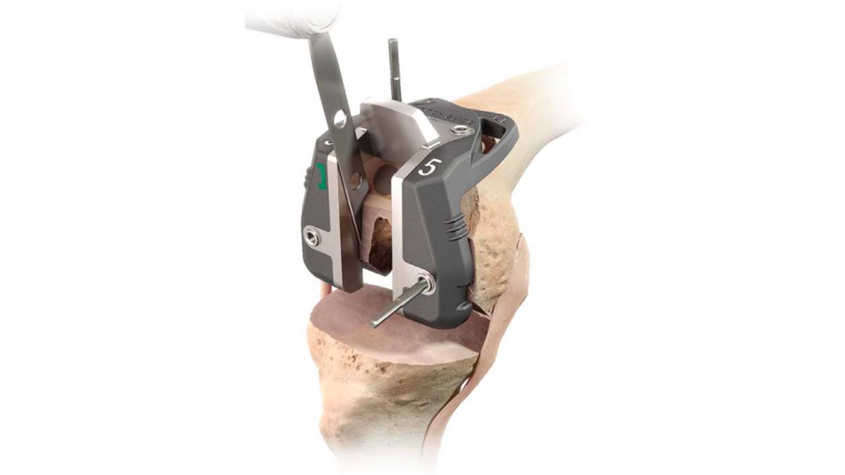 notch cut being made in bone during total knee arthroplasty