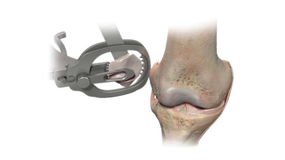  Patella resection guide used on patella