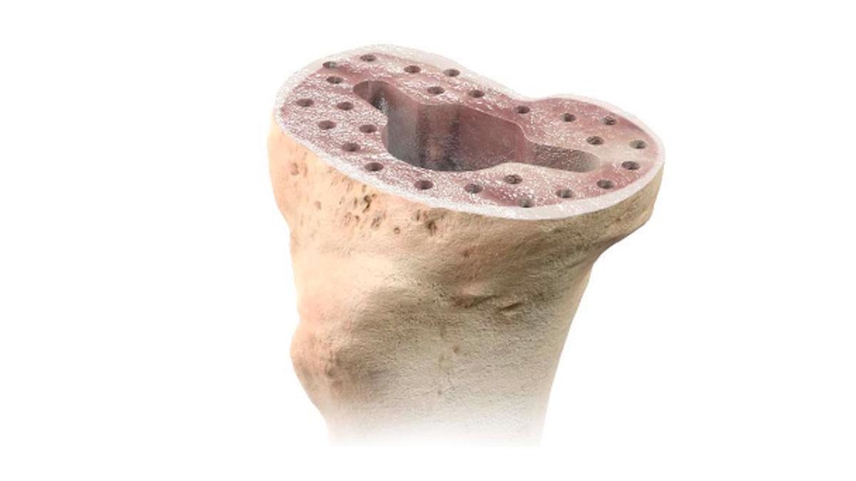 sclerotic bone with holes drilled
