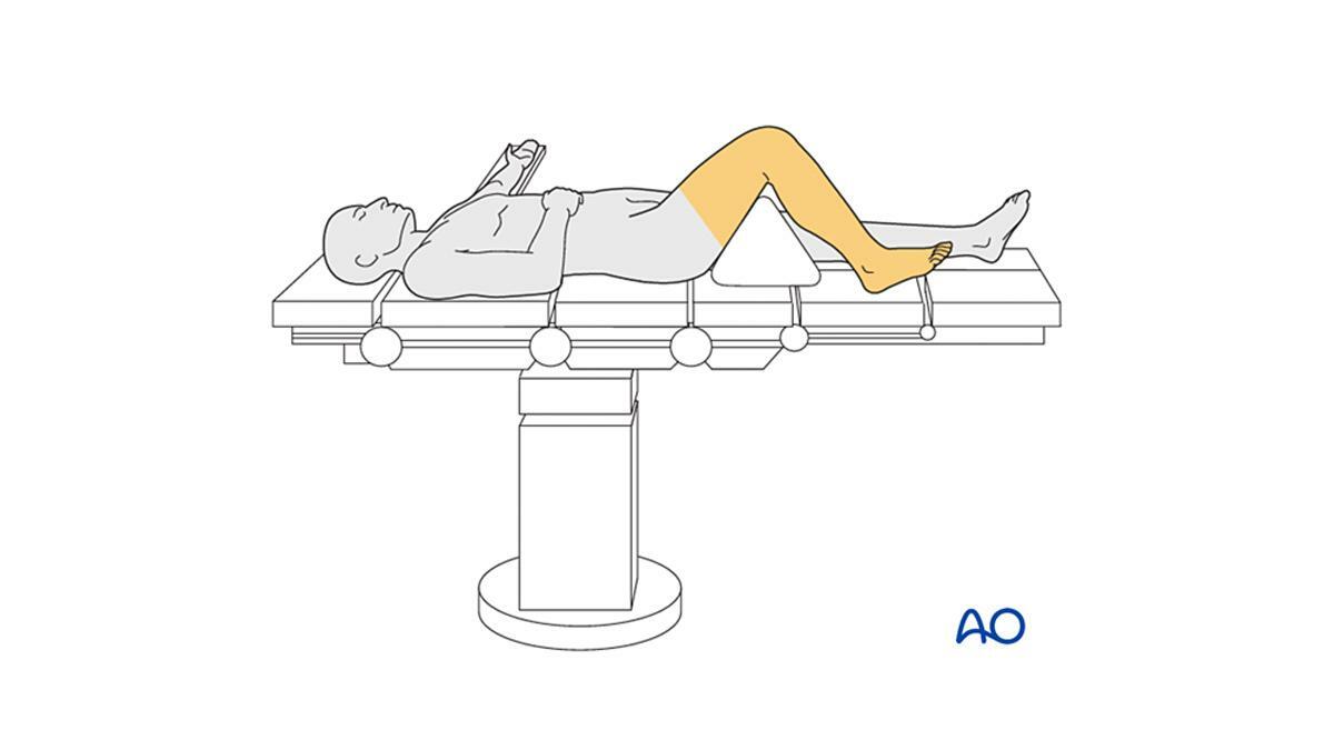 diagram of patient in supine position with knee flexed 90 degrees
