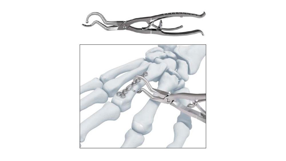 Variable Angle Locking Hand System plate holding forceps attaching plate to the hand bone