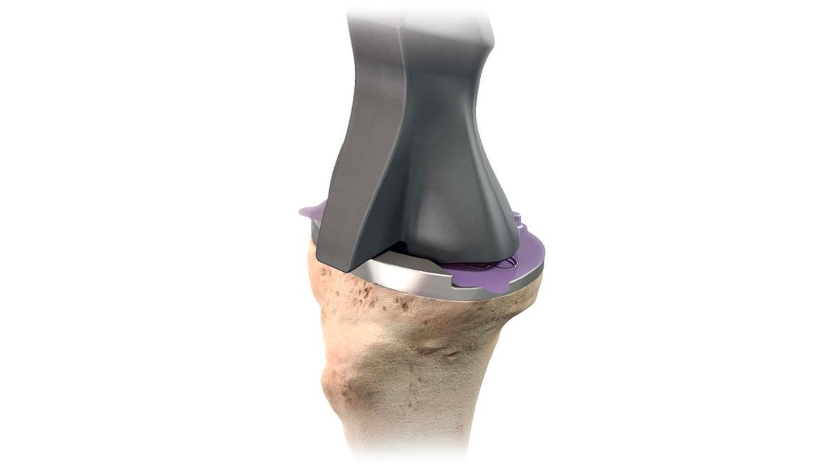 tibial base implant on bone