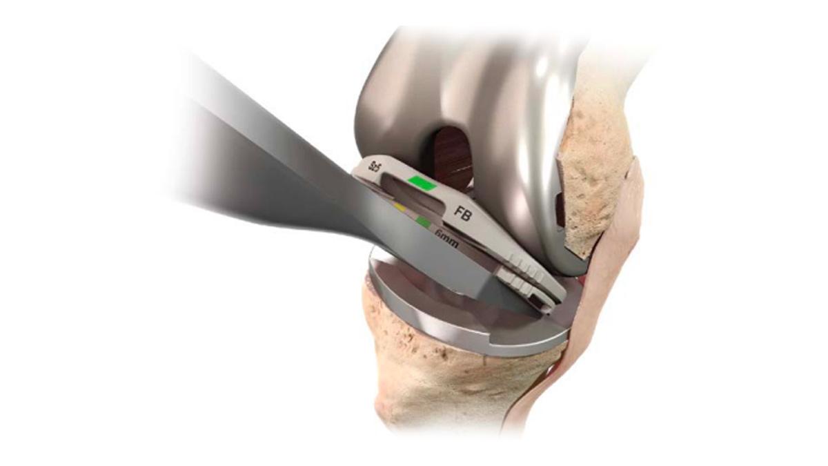  tibial trial extractor on knee