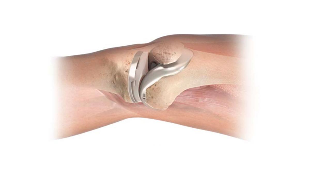 transparent knee showing ATTUNE™ Knee System implant inside of knee bones