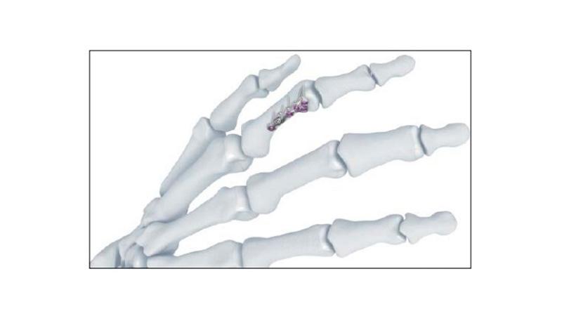 Variable Angle Locking Hand System Phalangeal Head Screw Plate Placement on hand bone