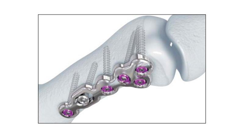 Variable Angle Locking Hand System Phalangeal Head Screw Plate and Screw Placement on hand bone close-up