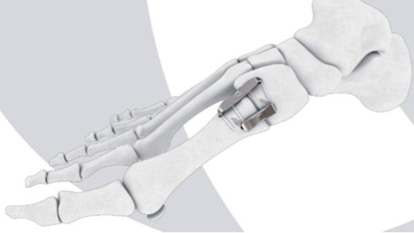  Foot bones with BME ELITETM Continuous Compression Implant attached.