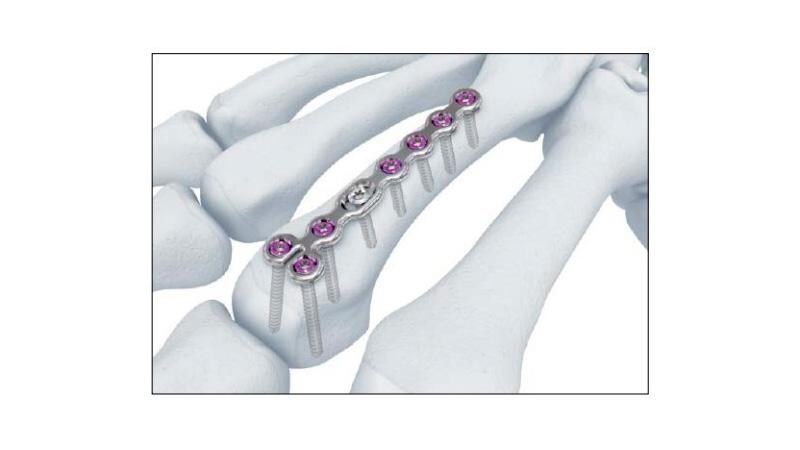 Variable Angle Locking Hand System Condylar Plate and Screws Placement on hand