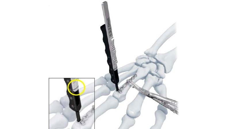 Variable Angle Locking Hand System Depth Gauge used on hand to measure screw length