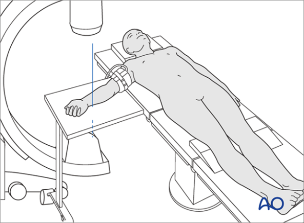 Patient placed in the supine position in preparation for application of the Variable Angle Locking Hand System for fracture repair or deformity correction