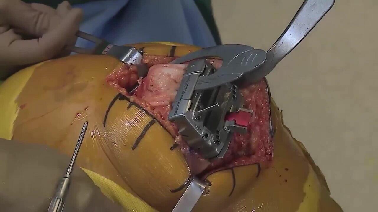 Procedure Hub ATTUNE Femoral Prep Gorab