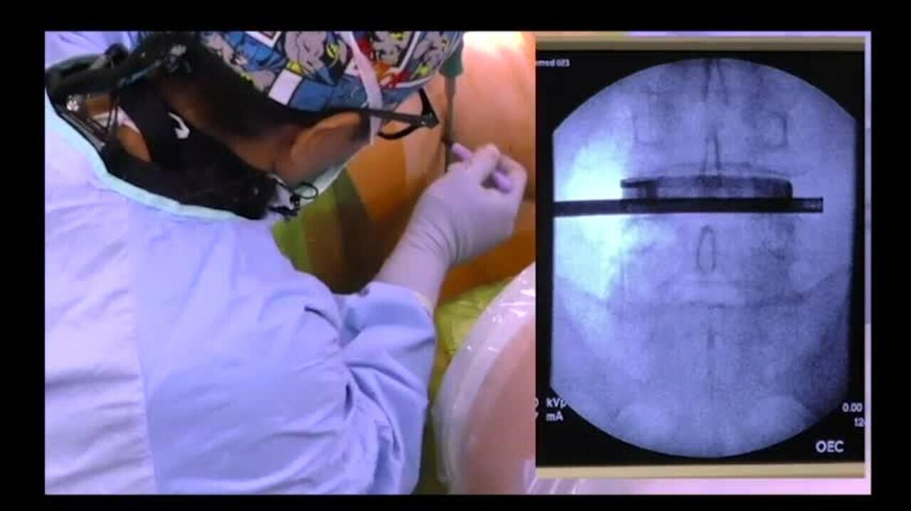ATP Screw Placement