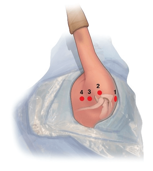 Position Patient and Mark Portals