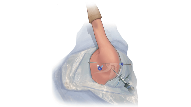 Create the Medial Portal (Halifax Portal)