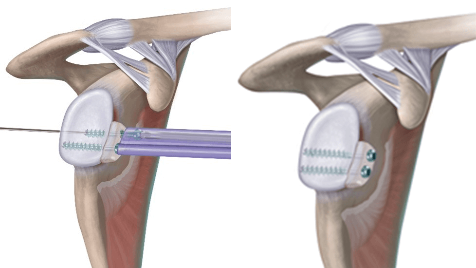 Graft Fixation 1