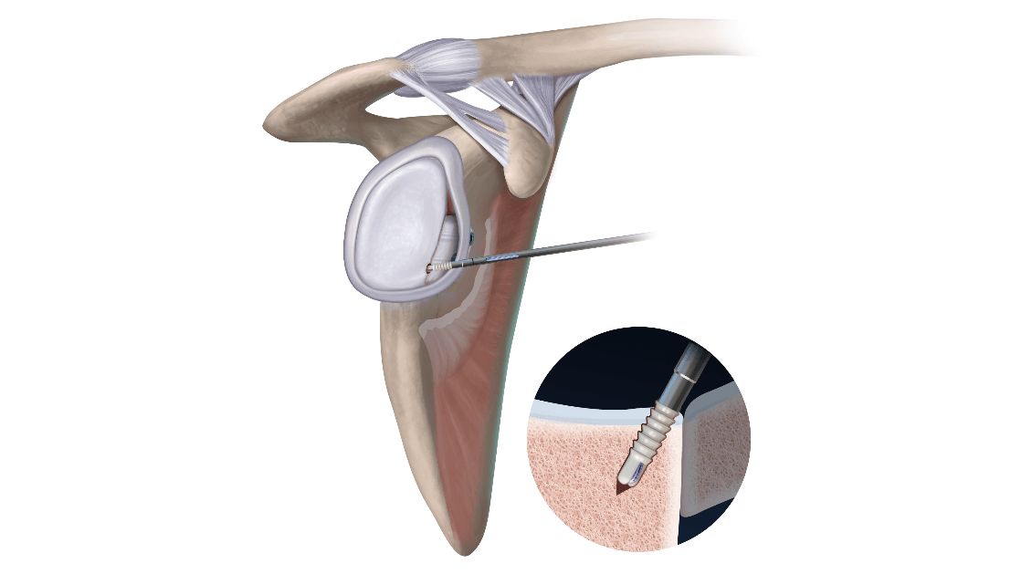 Reattach the Anterior-Inferior Labral Tissue to the Native Glenoid