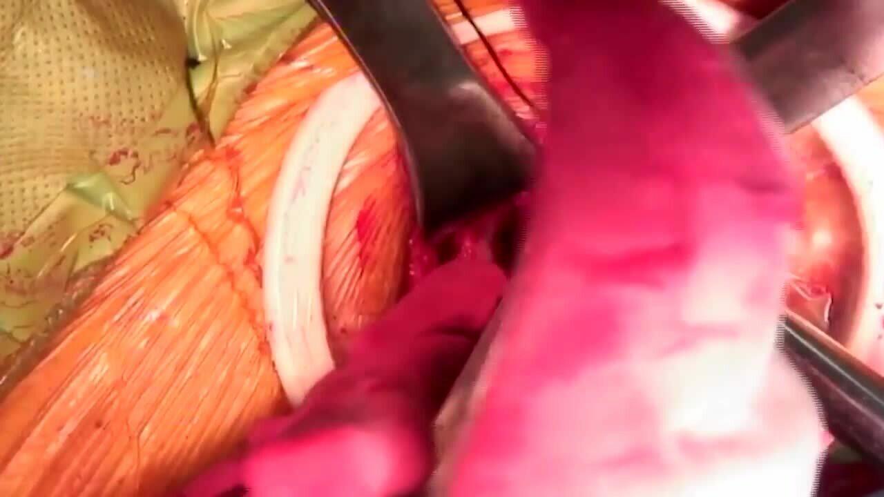 AA THA Femoral Preparation Matta MD