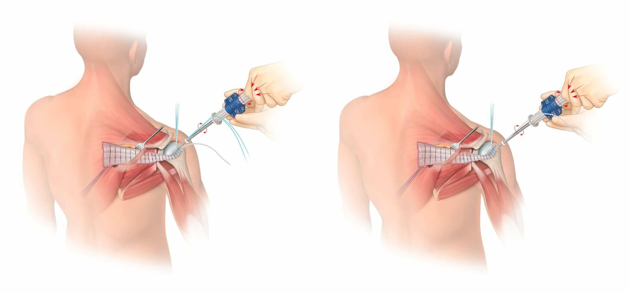 Allograft Intra-articular Attachment 1