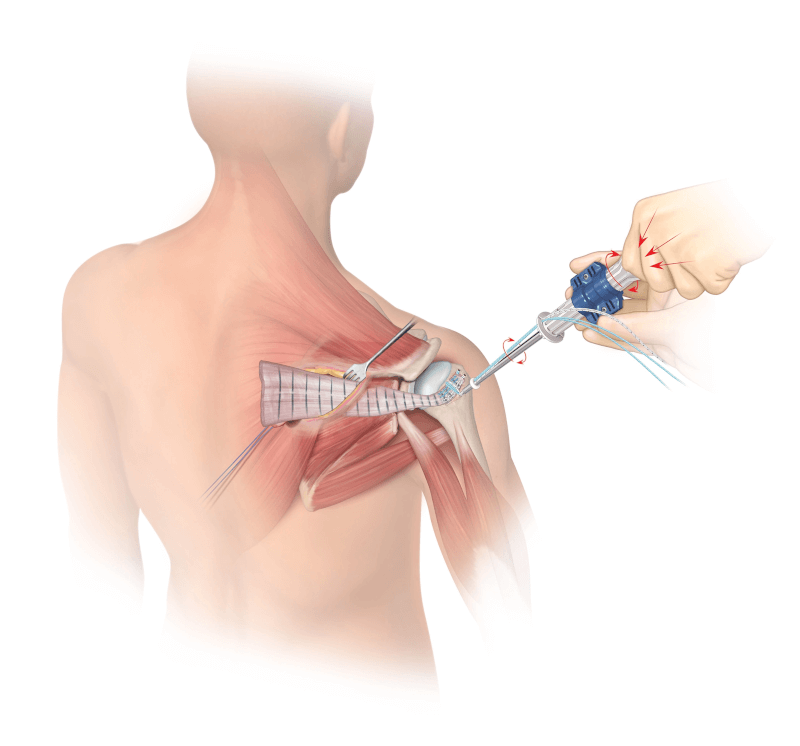 Insert the Posterior HEALIX ADVANCE™ Self-Punching Anchor