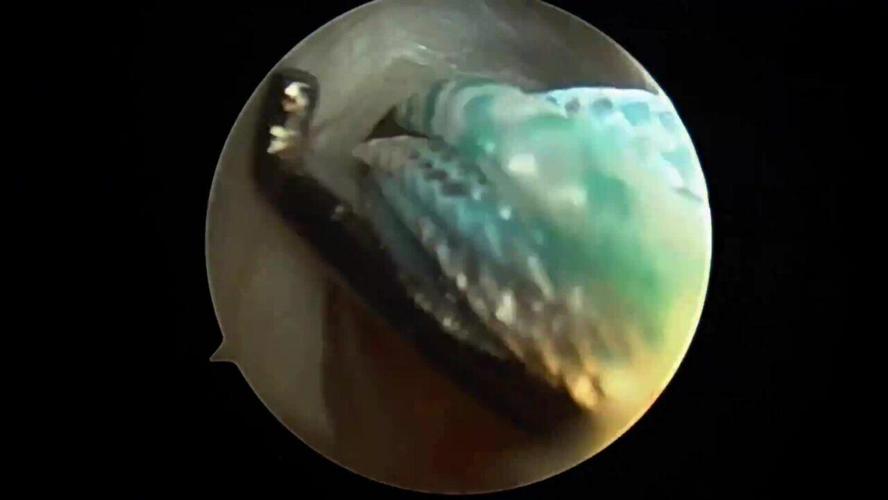 The DYNASEAL™ Procedure for Rotator Cuff Repair Featuring Dr. David Weinstein