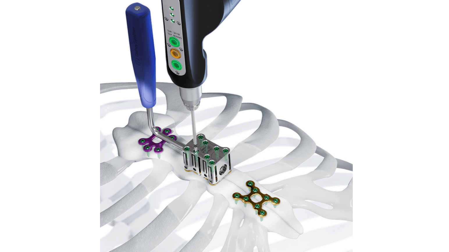 The MatrixSTERNUM Fixation System shown being affixed to bones of sternum 