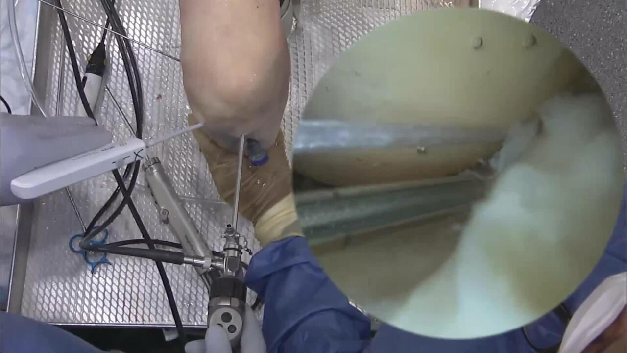 TRUESPAN Meniscal Repair System Featuring Dr. Anthony Scillia