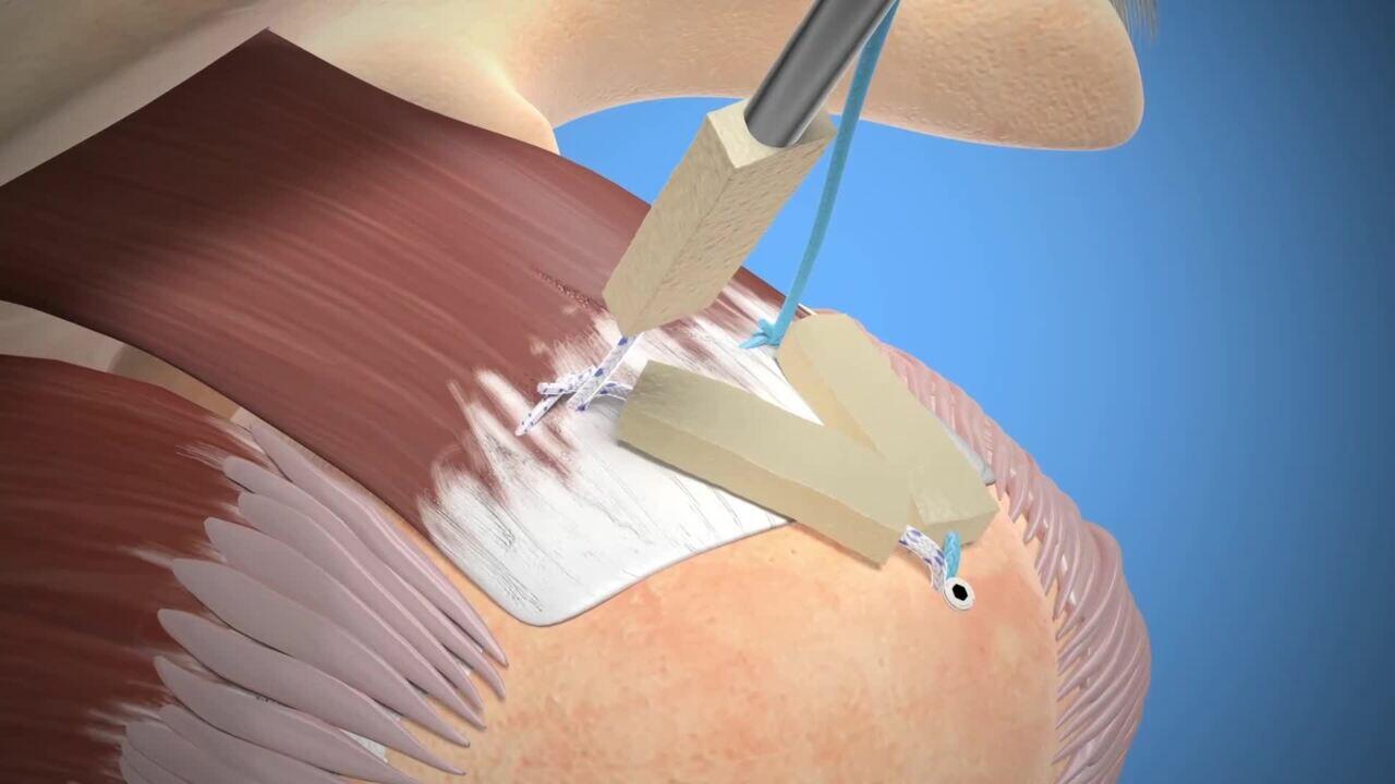 DERMIS ON DEMAND Allograft 'The 30 Second Augment'