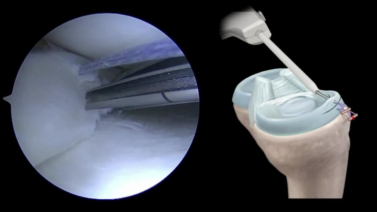 TRUESPAN  - All Inside Anterior Meniscal Repair Video Tony Nguyen