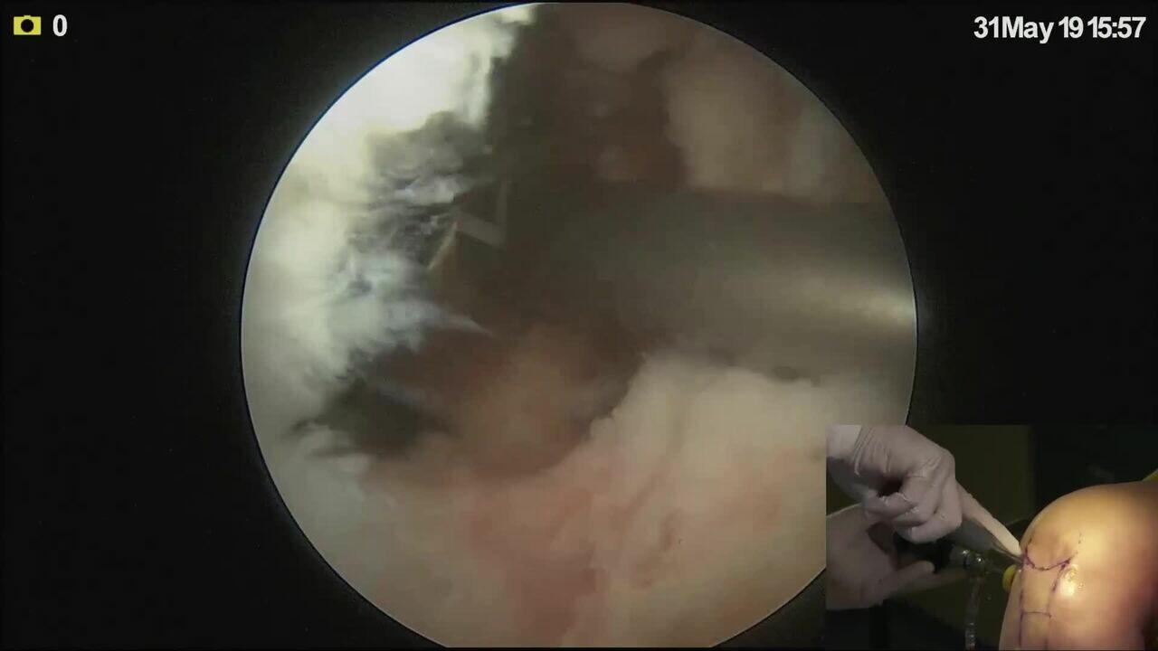 Posterior Cruciate Ligament (PCL) Reconstruction with Tibialis Anterior Allograft Featuring TWISTER Featuring Vishal Mehta, MD