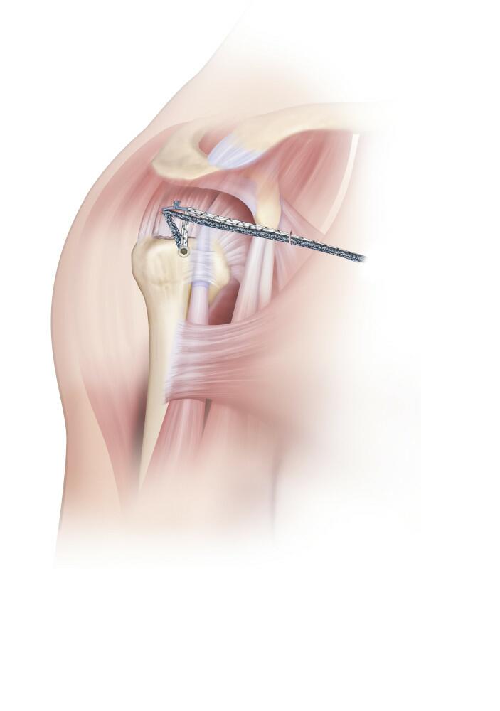 Medial Repair Construct is secured to Bone