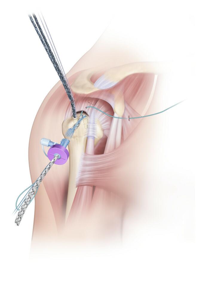 DYNATAPE™ Sutures & DYNACORD™ Suture are loaded