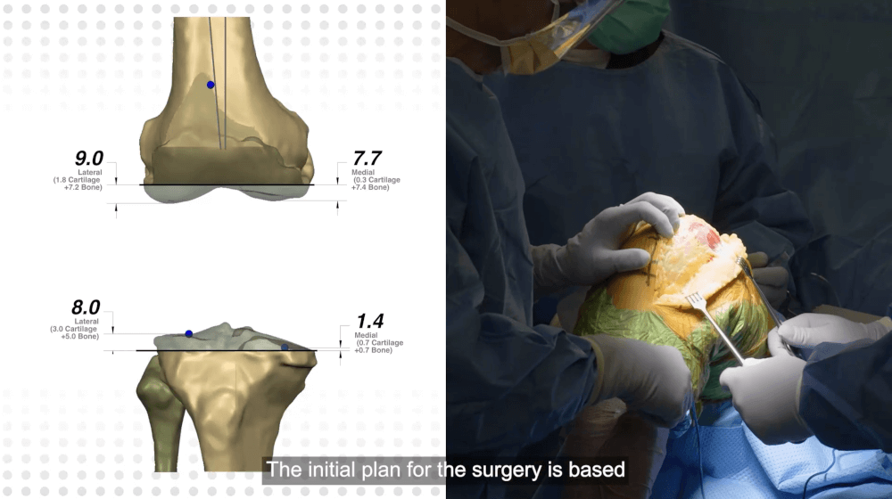 TRUMATCH™ Personalized Solutions ATTUNE™ Knee System Live Surgical Procedure